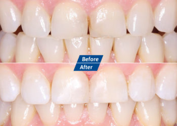 Teeth whitening Before After