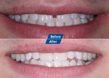 Root Canal Before After