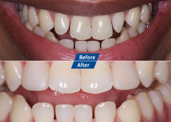 Dental Implants Before After