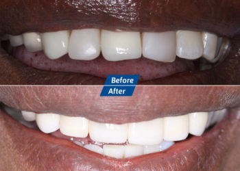 Teeth whitening Before After