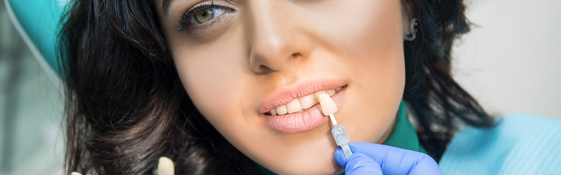 DENTAL VENEERS IN KATY, TX