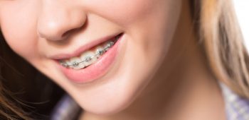 Braces & Your Oral Hygiene Routine