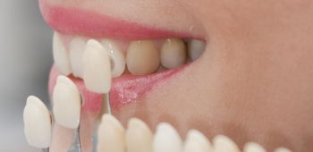 Could Dental Veneers Change Your Life?